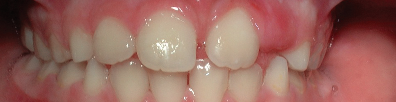 LM-Activator crossbite