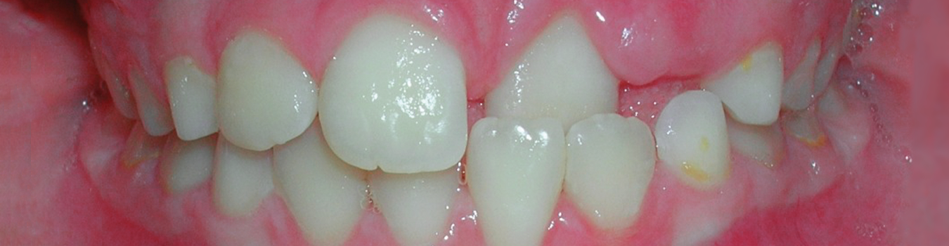 LM-Activator crossbite