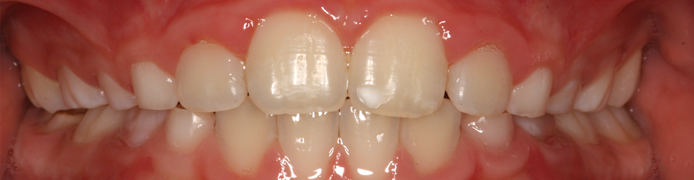 LM-Activator deepbite