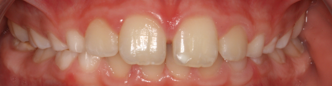 LM-Activator deepbite