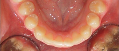 LM-Activator crowding