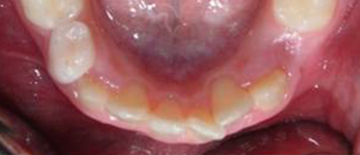 LM-Activator crowding 