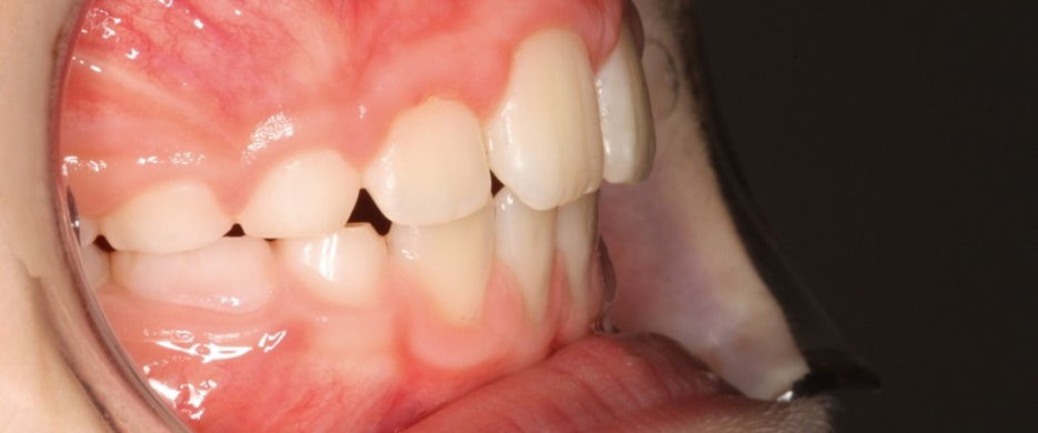 LM-Activator overjet