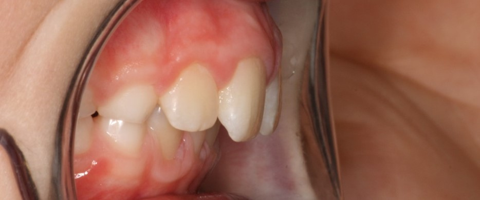 LM-Activator overjet