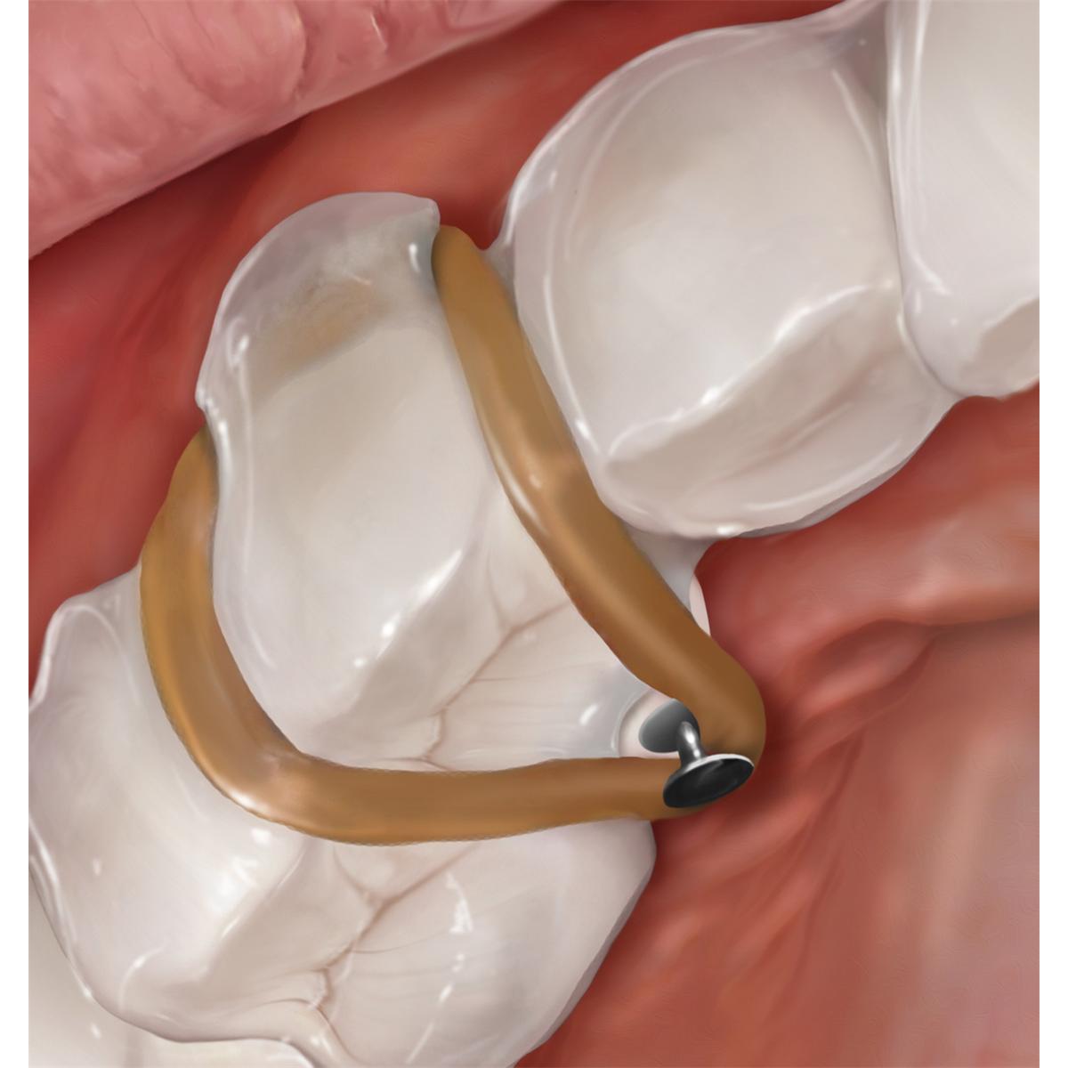 Pince pour aligners encoche - Mod�le 678-800