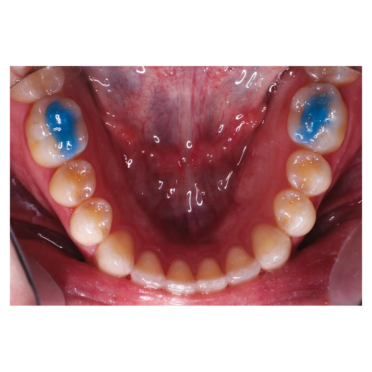 Ultra Band-Lok Blue Shade in Push Syringe - REF. NFUBLBPP, spuitje 5 g